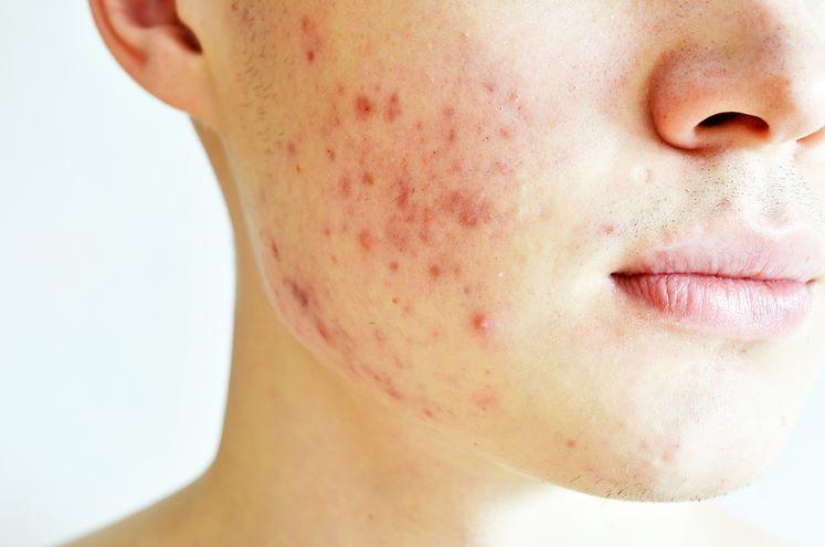 Can propolis help with acne?